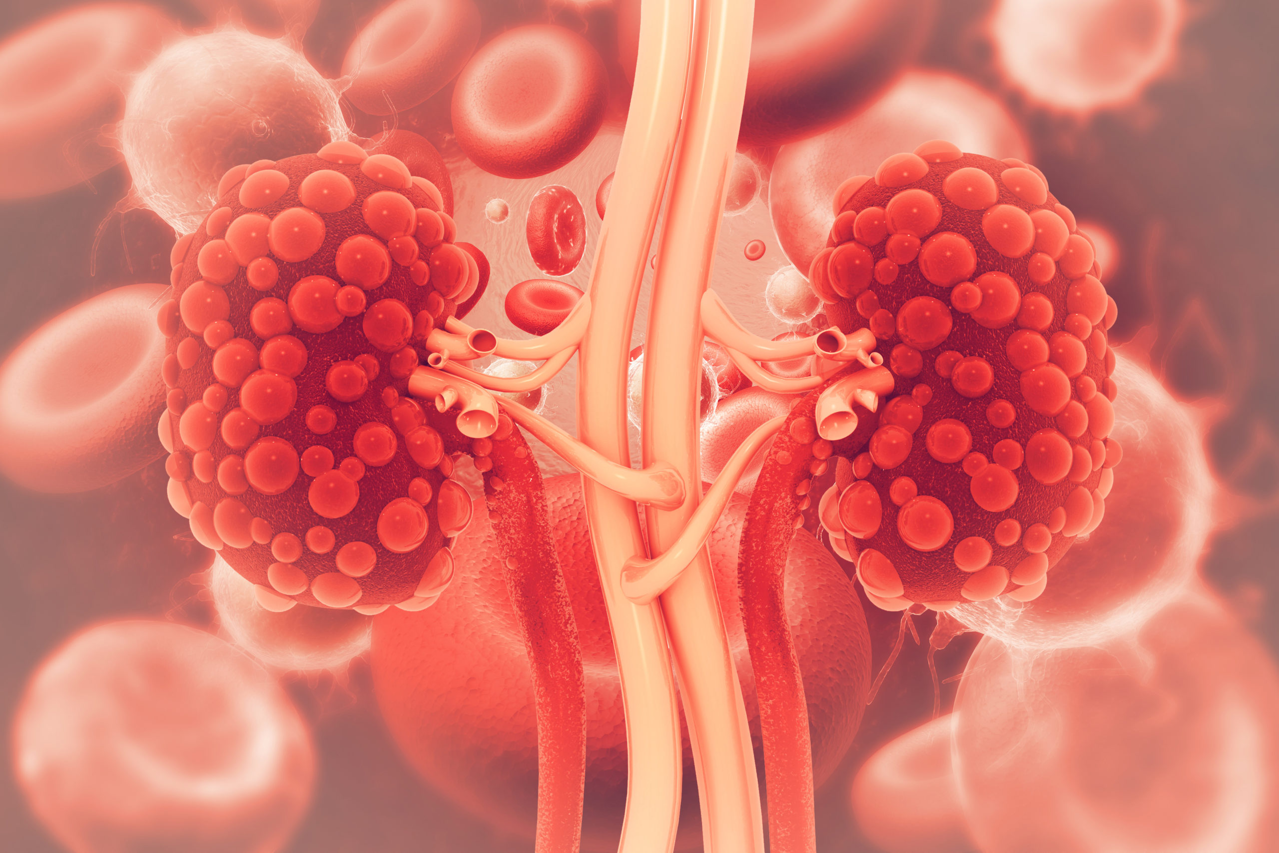 Kidney Stones Smart Nutrition